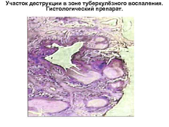 Участок деструкции в зоне туберкулёзного воспаления. Гистологический препарат. 