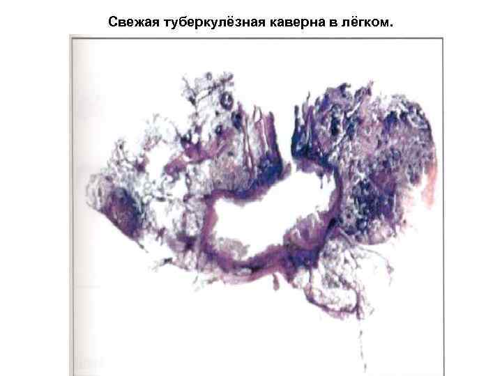 Свежая туберкулёзная каверна в лёгком. 