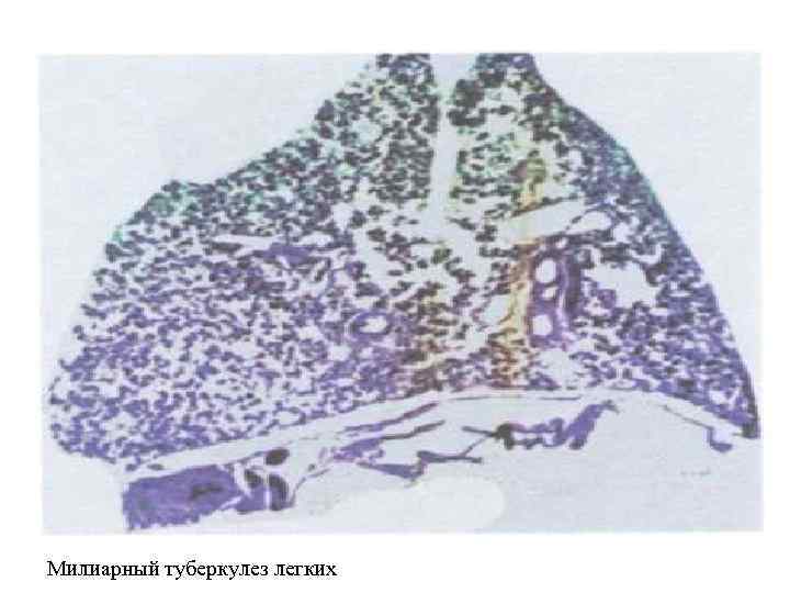 Милиарный туберкулез легких 