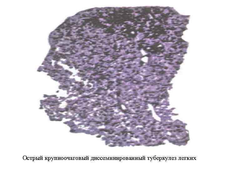 Острый крупноочаговый диссеминированный туберкулез легких 