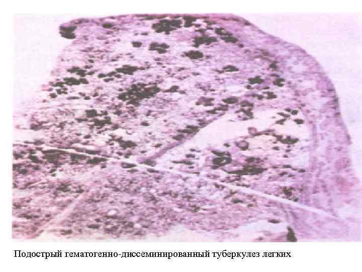Подострый гематогенно-диссеминированный туберкулез легких 
