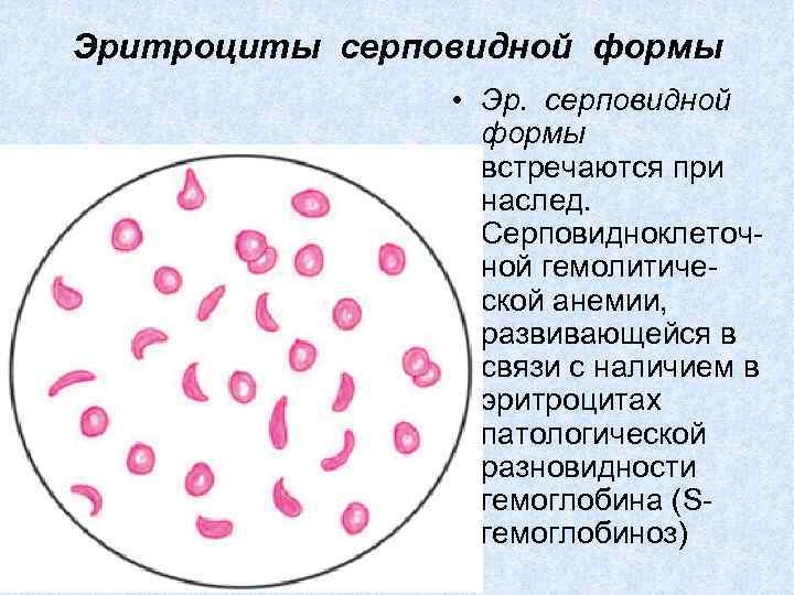 Эритроциты при серповидно клеточной анемии. Картина крови при серповидноклеточной анемии. Серповидноклеточная анемия эритроциты. Серповидноклеточная анемия мазок. Эритроциты мазок гипохромия.