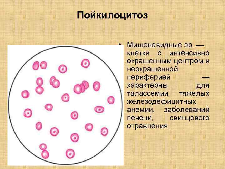 Пойкилоцитоз • Мишеневидные эр. — клетки с интенсивно окрашенным центром и неокрашенной периферией —