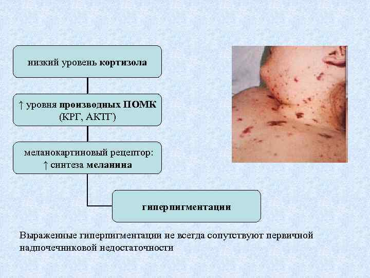 низкий уровень кортизола ↑ уровня производных ПОМК (КРГ, АКТГ) меланокартиновый рецептор: ↑ синтеза меланина