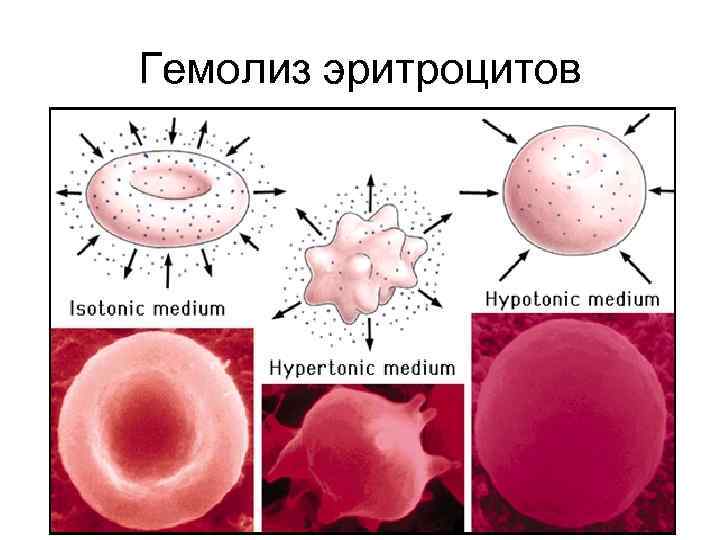 Гемолиз эритроцитов 