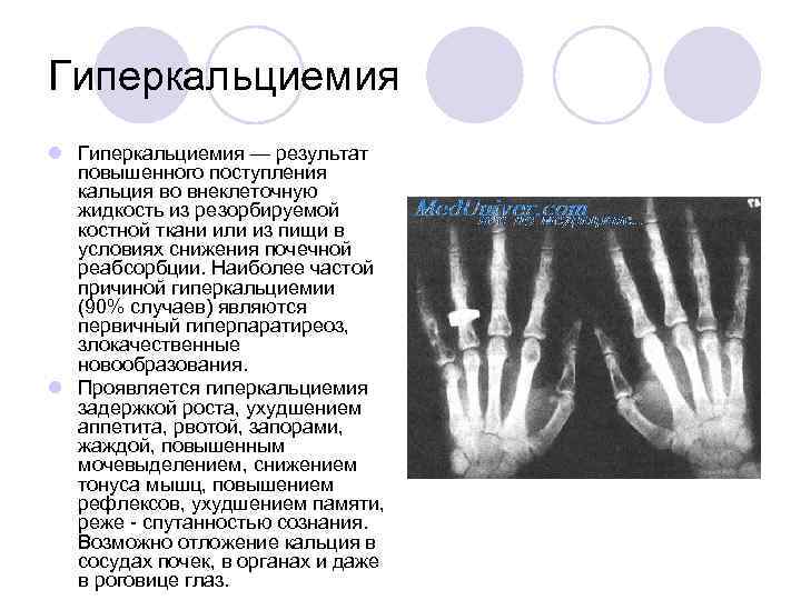 Гиперкальциемия l Гиперкальциемия — результат повышенного поступления кальция во внеклеточную жидкость из резорбируемой костной