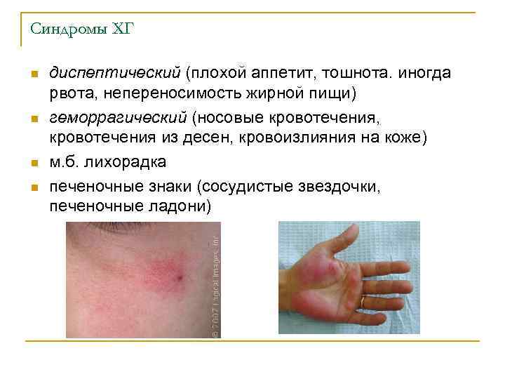 Синдромы ХГ n n диспептический (плохой аппетит, тошнота. иногда рвота, непереносимость жирной пищи) геморрагический