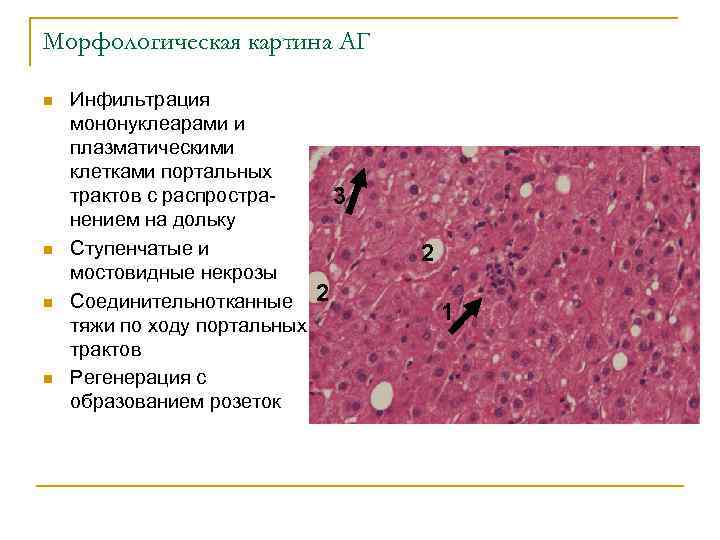 Морфологическая картина АГ n n Инфильтрация мононуклеарами и плазматическими клетками портальных трактов с распростра