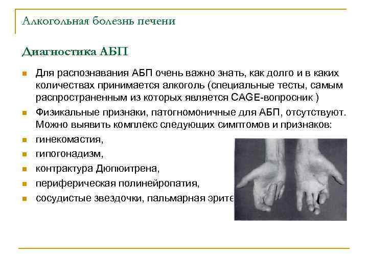 Алкогольная болезнь печени Диагностика АБП n n n n Для распознавания АБП очень важно
