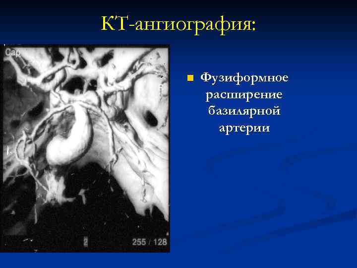 КТ-ангиография: n Фузиформное расширение базилярной артерии 