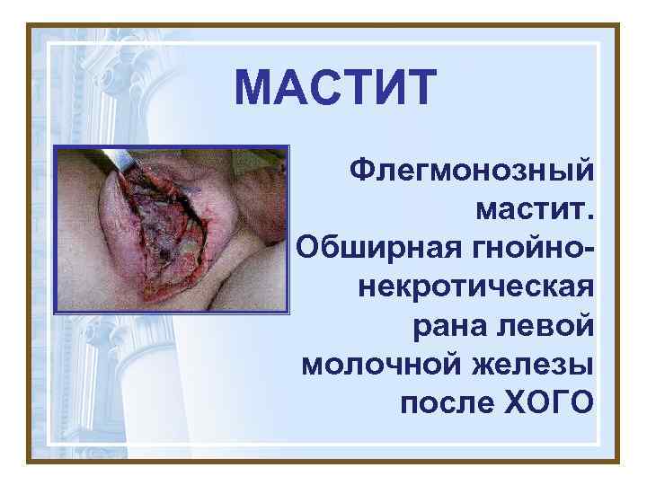 МАСТИТ Флегмонозный мастит. Обширная гнойнонекротическая рана левой молочной железы после ХОГО 