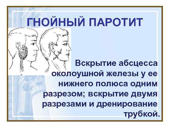 ГНОЙНЫЙ ПАРОТИТ Вскрытие абсцесса околоушной железы у ее нижнего полюса одним разрезом; вскрытие двумя