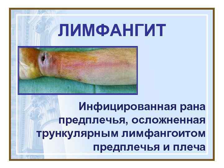 ЛИМФАНГИТ Инфицированная рана предплечья, осложненная трункулярным лимфангоитом предплечья и плеча 