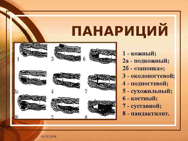 1 кожный. Кожный панариций в виде запонки. Панариций классификация мкб. Подкожный панариций мкб.