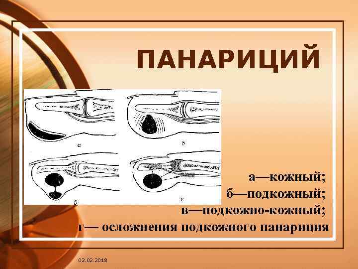 Панариций мазь. Хирургия панариций подкожный. Осложнения подкожного панариция.