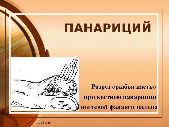 ПАНАРИЦИЙ Разрез «рыбья пасть» при костном панариции ногтевой фаланги пальца 02. 2018 