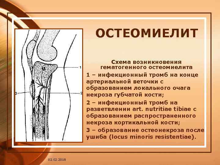 ОСТЕОМИЕЛИТ Схема возникновения гематогенного остеомиелита 1 – инфекционный тромб на конце артериальной веточки с