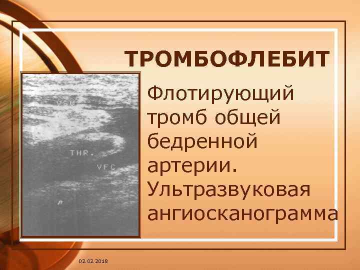 ТРОМБОФЛЕБИТ Флотирующий тромб общей бедренной артерии. Ультразвуковая ангиосканограмма 02. 2018 