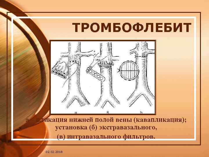 ТРОМБОФЛЕБИТ а – пликация нижней полой вены (кавапликация); установка (б) экстравазального, (в) интравазального фильтров.