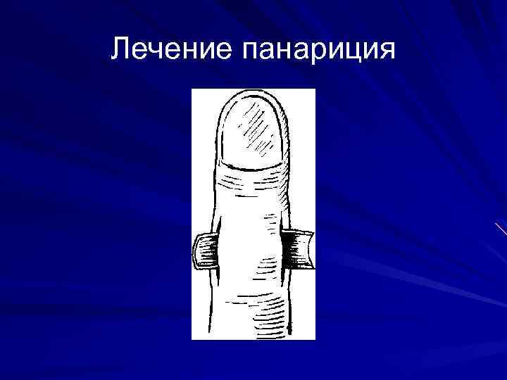 Лечение панариция 