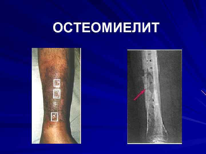 ОСТЕОМИЕЛИТ 