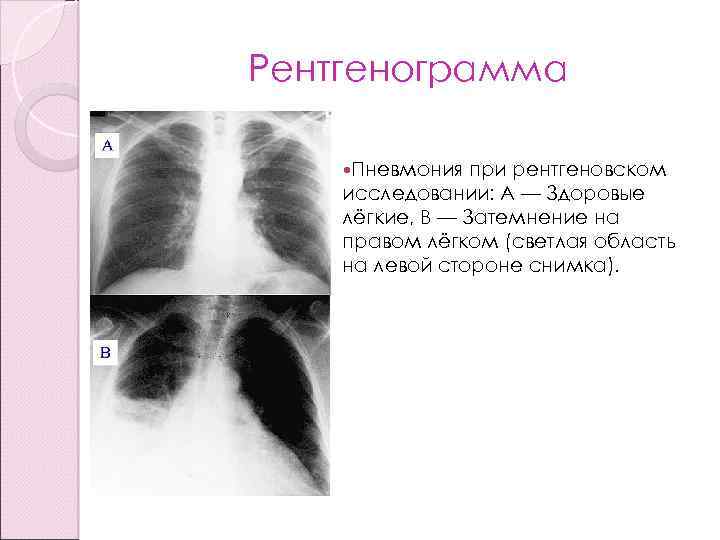 Рентгенограмма Пневмония при рентгеновском исследовании: А — Здоровые лёгкие, В — Затемнение на правом