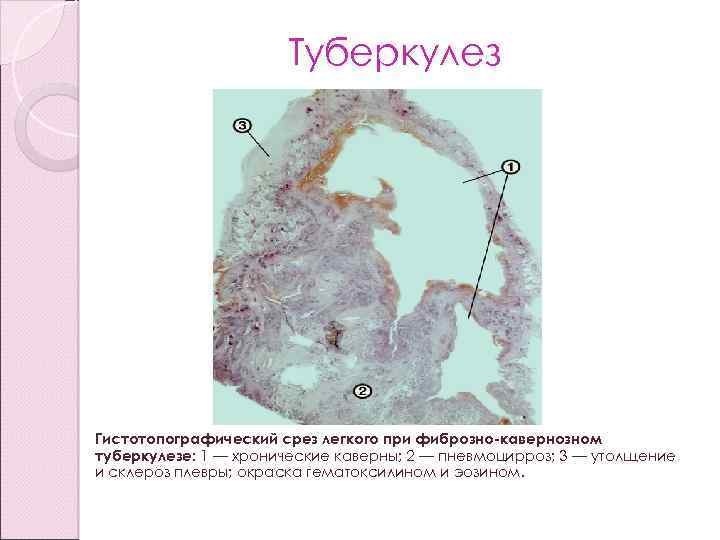 Туберкулез Гистотопографический срез легкого при фиброзно-кавернозном туберкулезе: 1 — хронические каверны; 2 — пневмоцирроз;