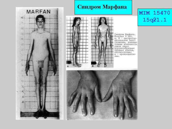 Синдром Марфана MIM 15470 15 q 21. 1 