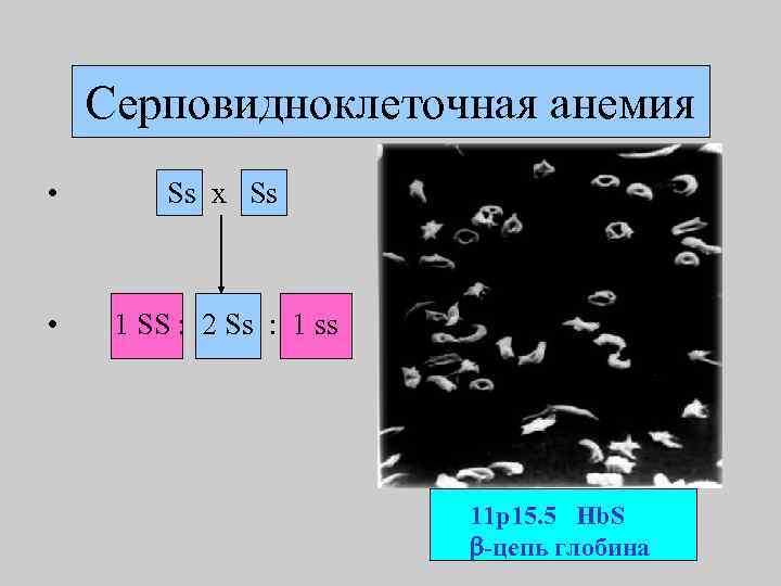 Серповидноклеточная анемия • Ss x Ss • 1 SS : 2 Ss : 1