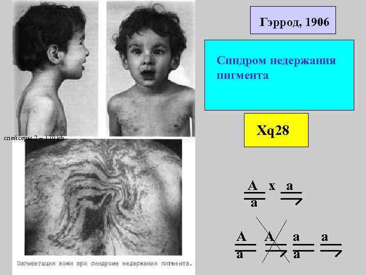 Гэррод, 1906 Синдром недержания пигмента Xq 28 спейсеры 2 – 170 kb А х