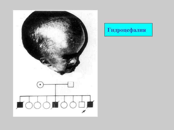 Гидроцефалия 