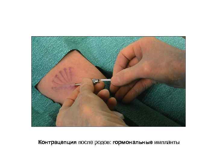Контрацепция после родов: гормональные импланты 
