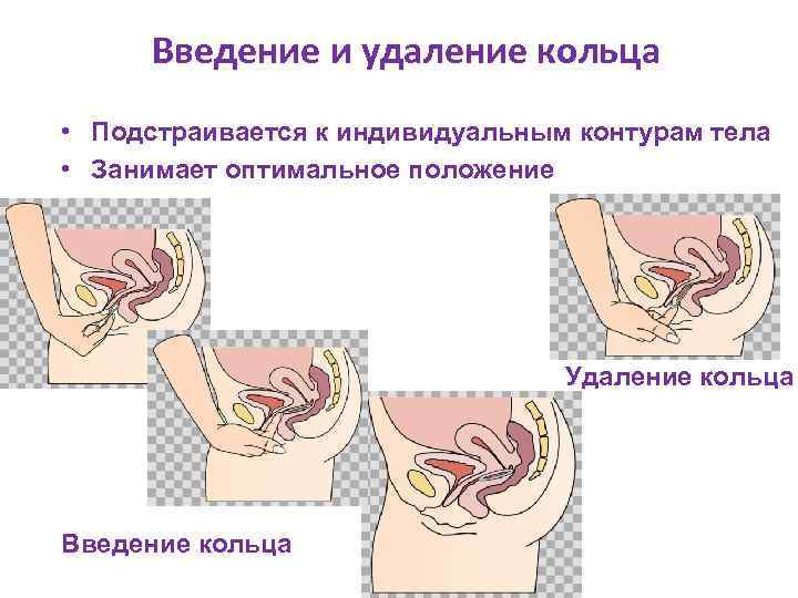 Введение и удаление кольца • Подстраивается к индивидуальным контурам тела • Занимает оптимальное положение