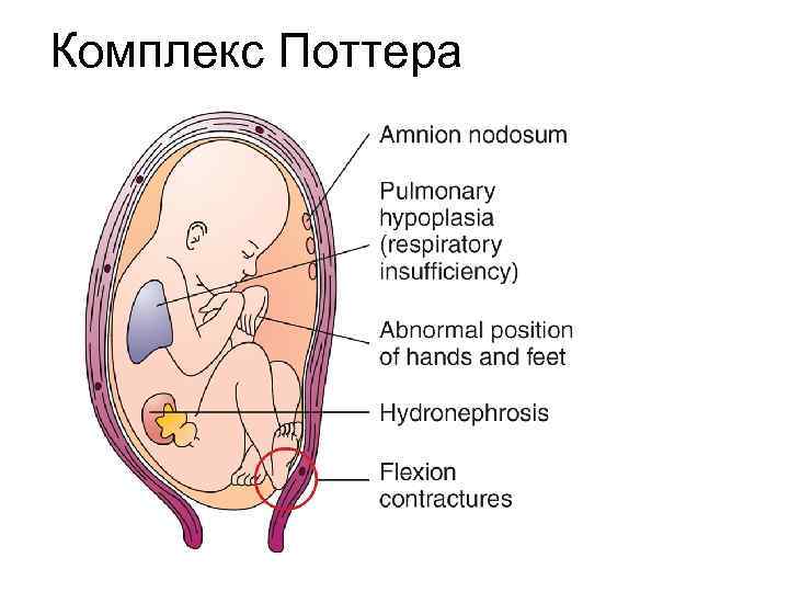 Комплекс Поттера 