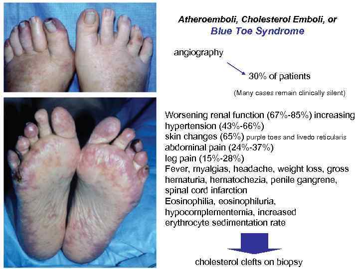 Atheroemboli, Cholesterol Emboli, or Blue Toe Syndrome angiography 30% of patients (Many cases remain