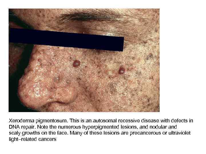 Xeroderma pigmentosum. This is an autosomal recessive disease with defects in DNA repair. Note