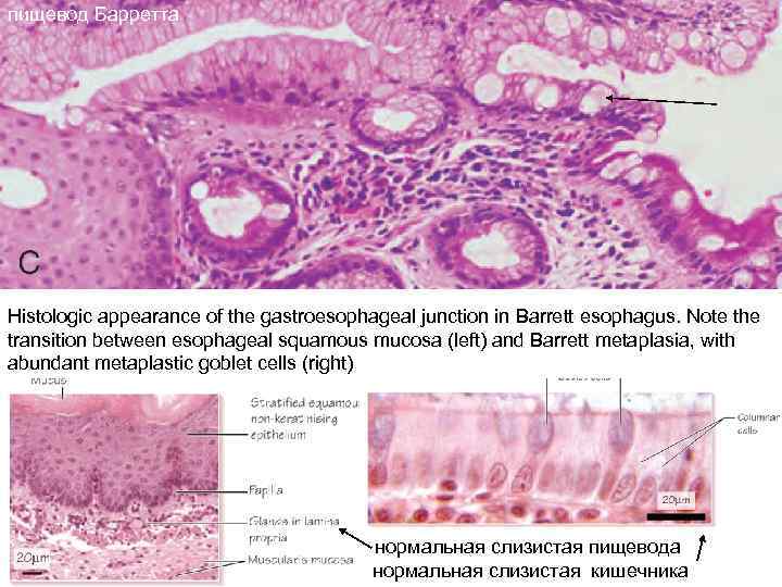 пищевод Барретта Histologic appearance of the gastroesophageal junction in Barrett esophagus. Note the transition