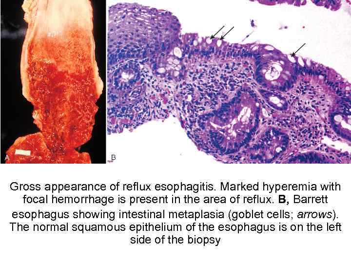 Gross appearance of reflux esophagitis. Marked hyperemia with focal hemorrhage is present in the