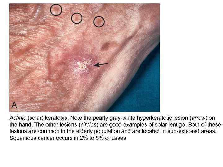 Actinic (solar) keratosis. Note the pearly gray-white hyperkeratotic lesion (arrow) on the hand. The
