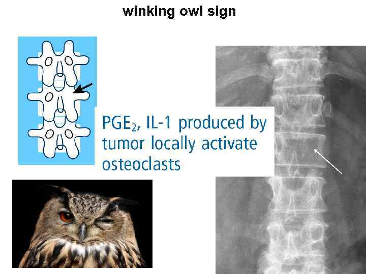winking owl sign 