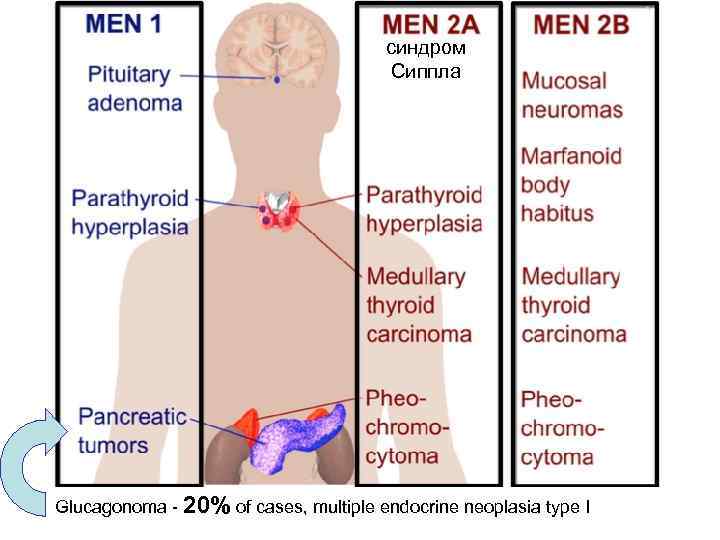 синдром Сиппла Glucagonoma - 20% of cases, multiple endocrine neoplasia type I 