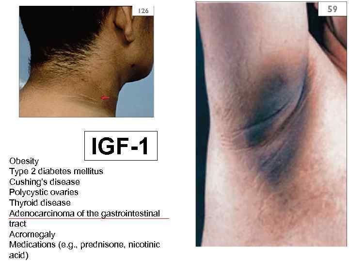 IGF-1 Obesity Type 2 diabetes mellitus Cushing’s disease Polycystic ovaries Thyroid disease Adenocarcinoma of