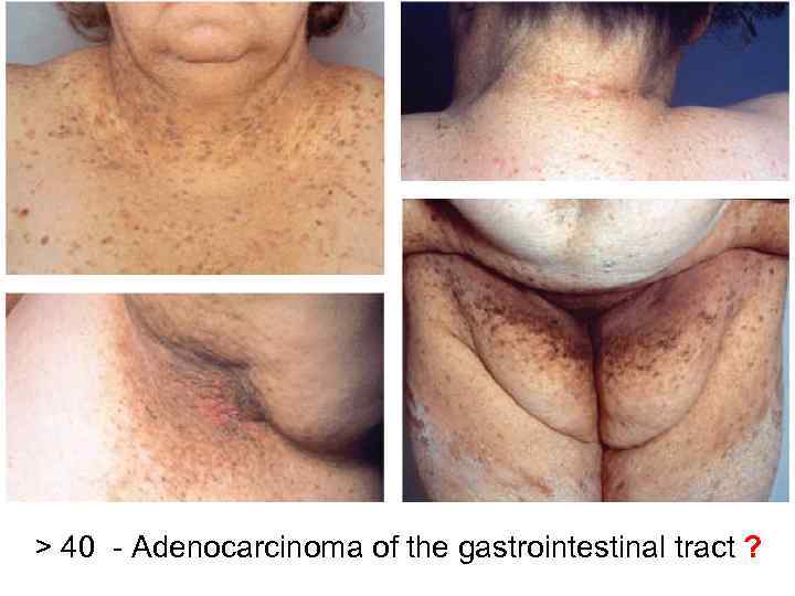 > 40 - Adenocarcinoma of the gastrointestinal tract ? 