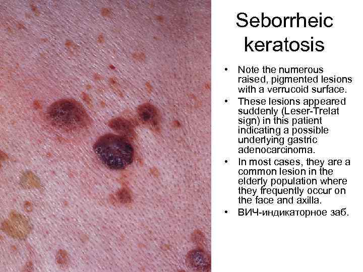 Seborrheic keratosis • Note the numerous raised, pigmented lesions with a verrucoid surface. •