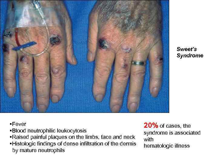 Sweet’s Syndrome §Fever §Blood neutrophilic leukocytosis §Raised painful plaques on the limbs, face and