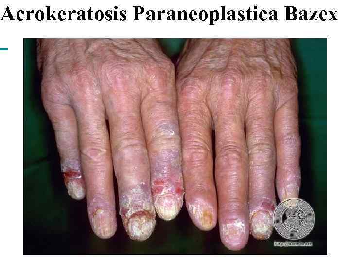 Acrokeratosis Paraneoplastica Bazex 