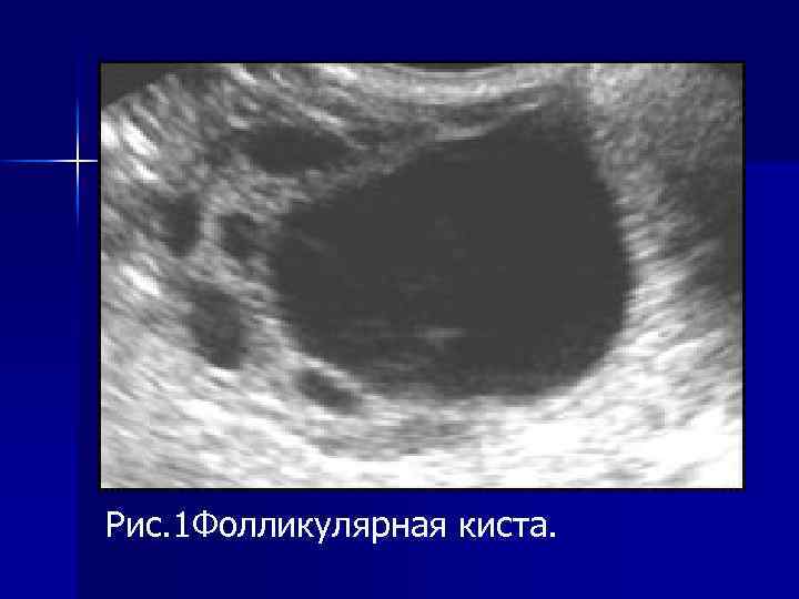 Рис. 1 Фолликулярная киста. 