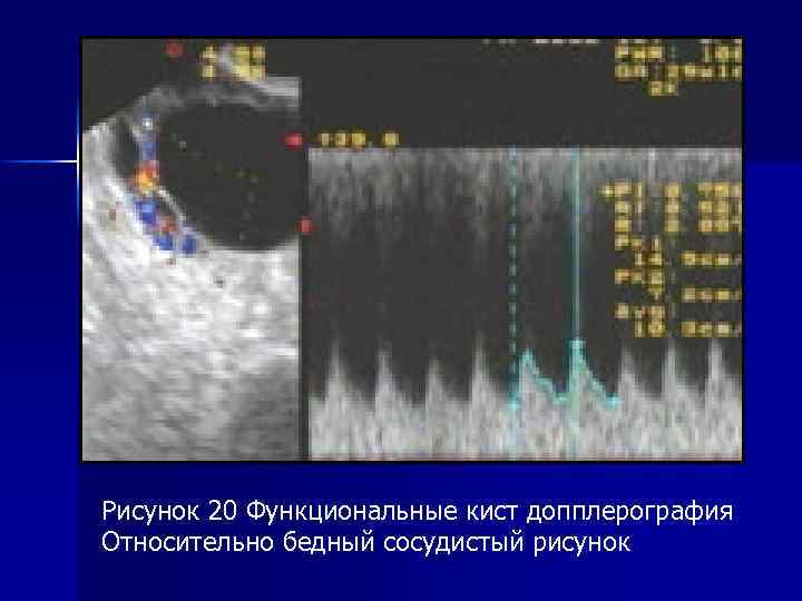 Рисунок 20 Функциональные кист допплерография Относительно бедный сосудистый рисунок 