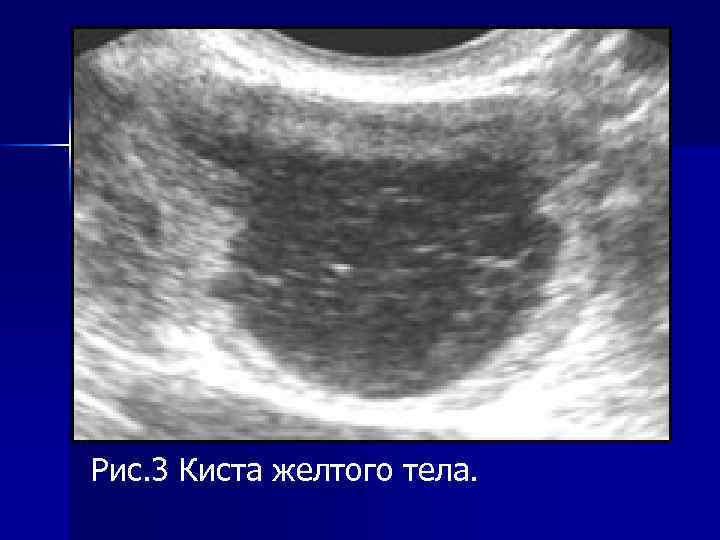 Рис. 3 Киста желтого тела. 