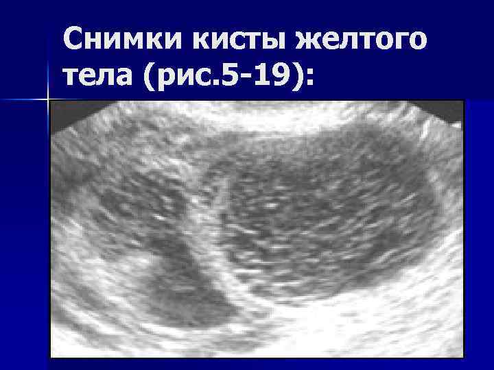 Снимки кисты желтого тела (рис. 5 -19): 